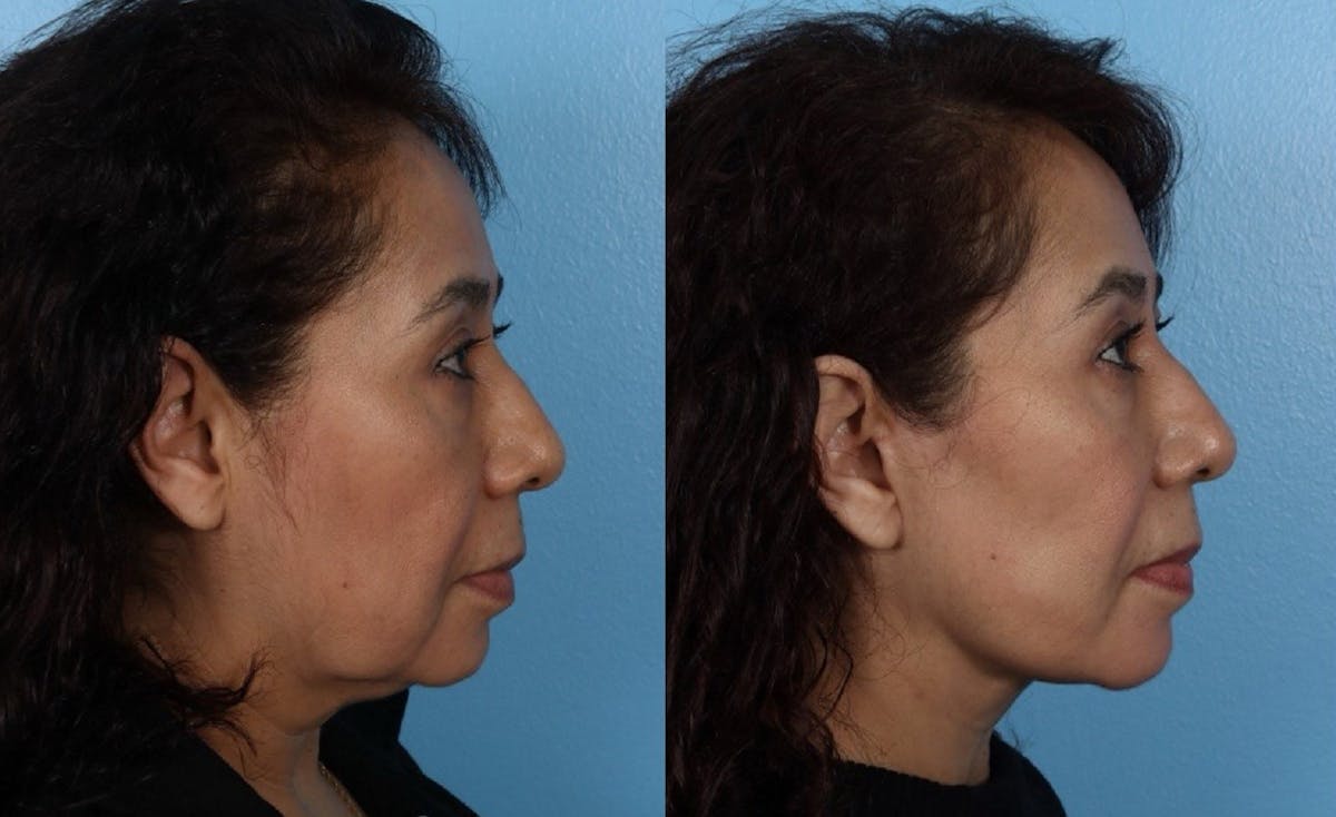 Facelift Before & After Gallery - Patient 984664 - Image 3