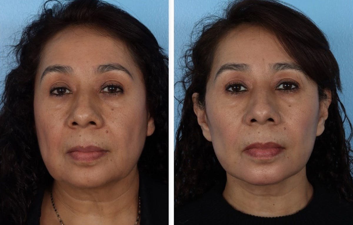 Facelift Before & After Gallery - Patient 984664 - Image 1