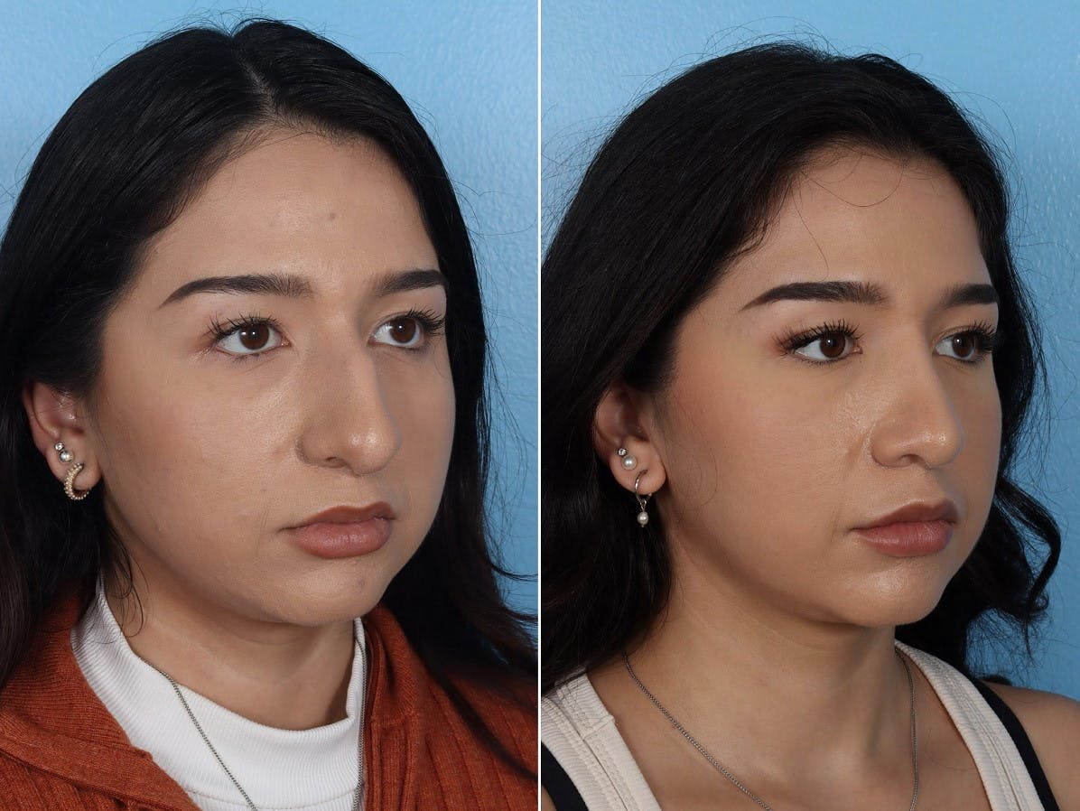 Rhinoplasty Before & After Gallery - Patient 916987 - Image 2