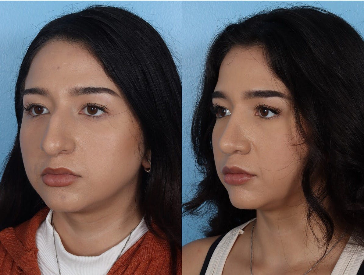 Rhinoplasty Before & After Gallery - Patient 916987 - Image 4
