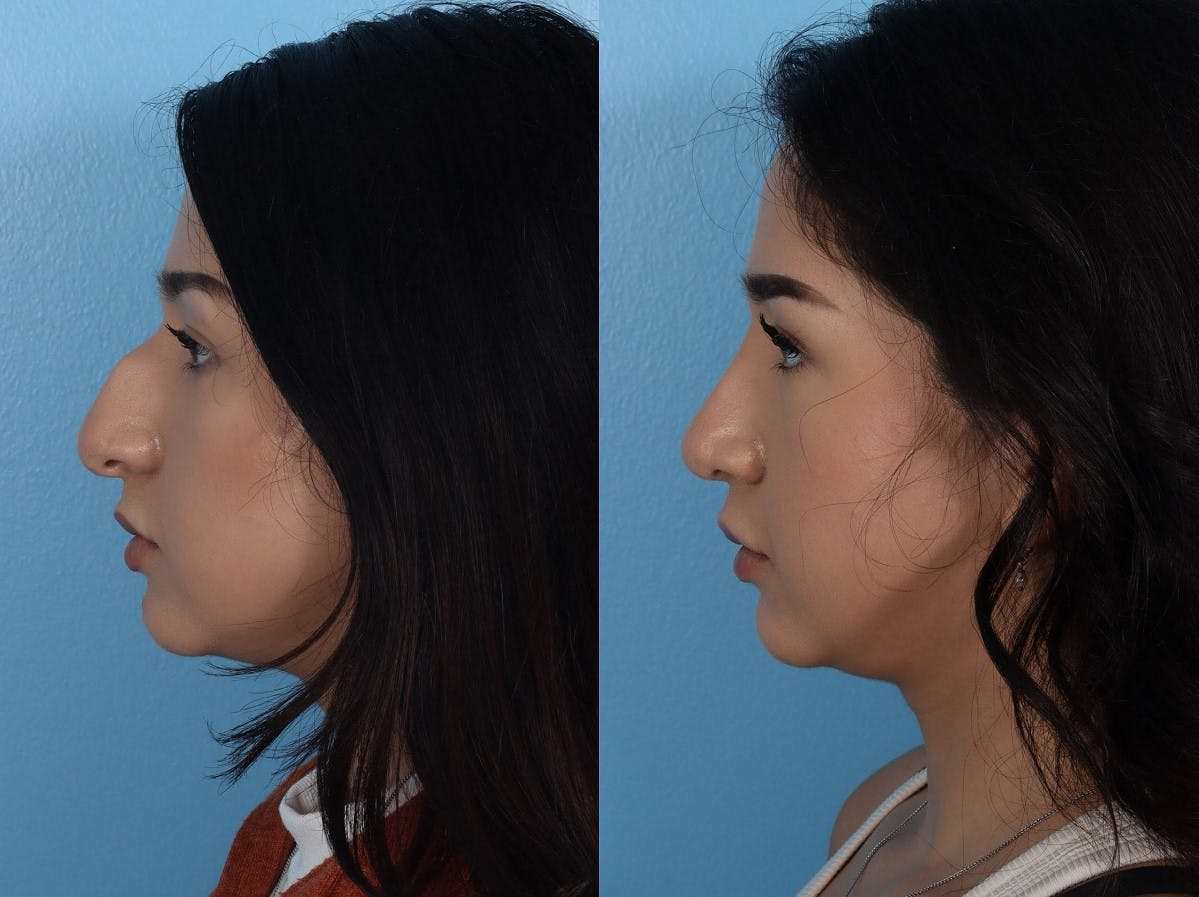 Rhinoplasty Before & After Gallery - Patient 916987 - Image 5