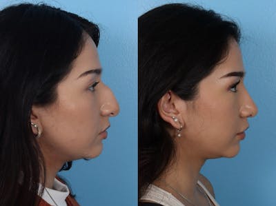 Rhinoplasty Before & After Gallery - Patient 916987 - Image 1