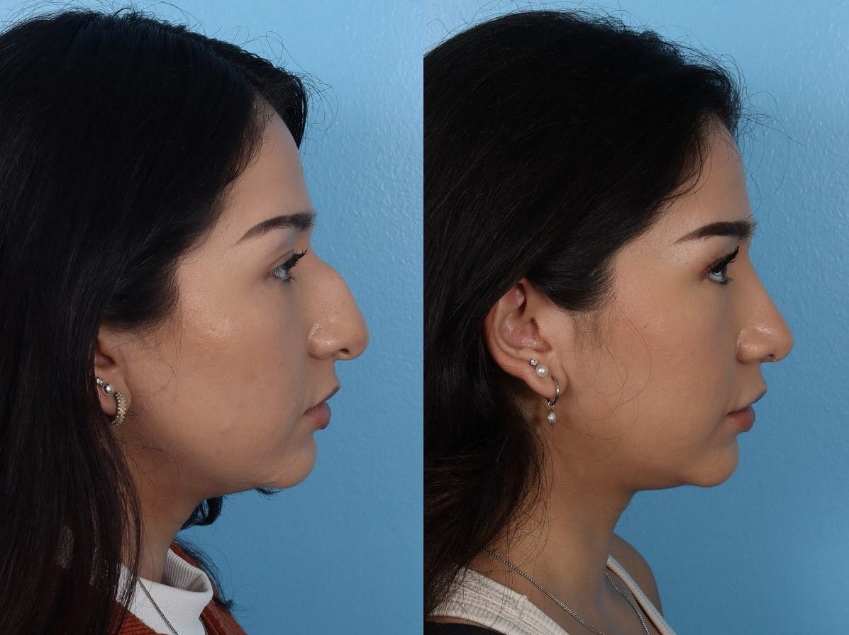 Rhinoplasty Before & After Gallery - Patient 916987 - Image 1