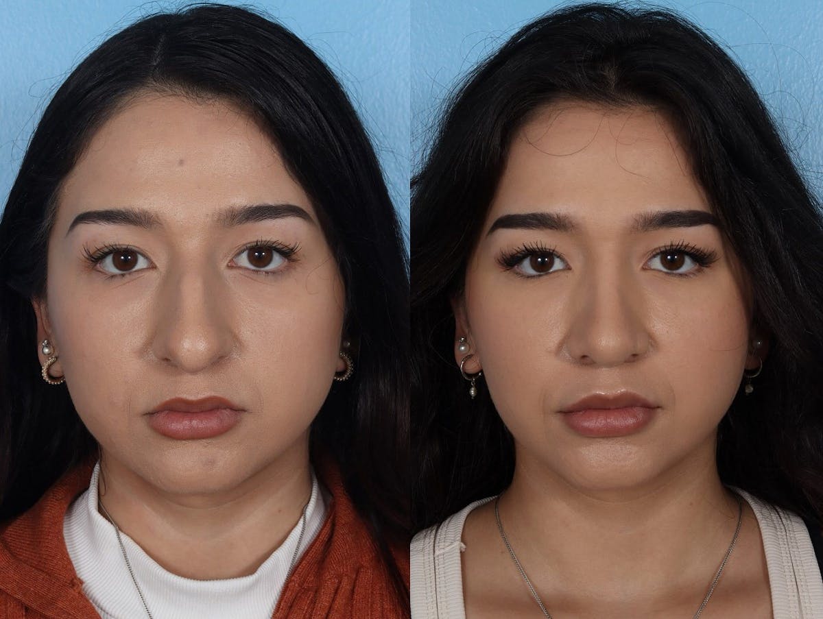 Rhinoplasty Before & After Gallery - Patient 916987 - Image 3