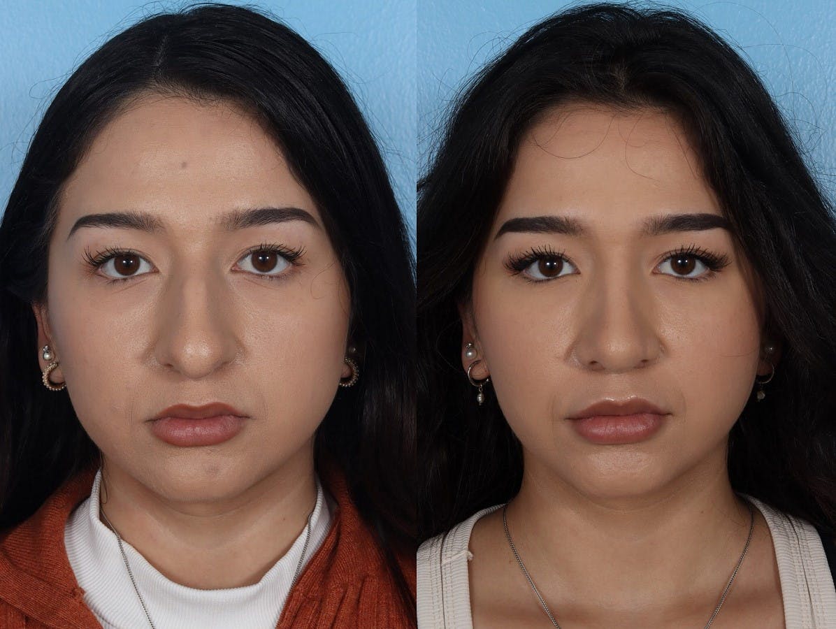 Rhinoplasty Before & After Gallery - Patient 916987 - Image 3