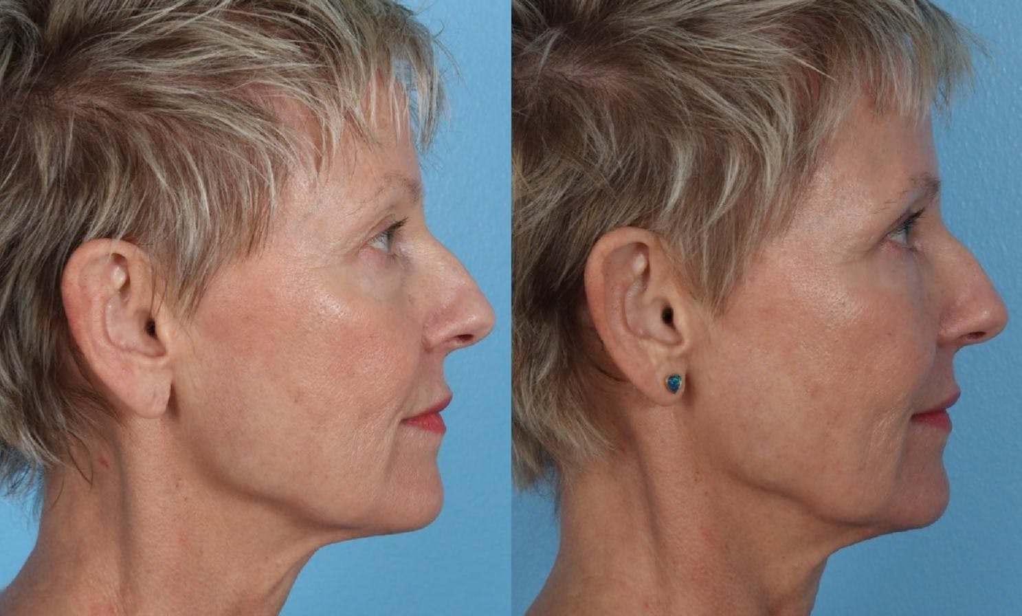 Limited Incision Facelift Before & After Gallery - Patient 289303 - Image 3