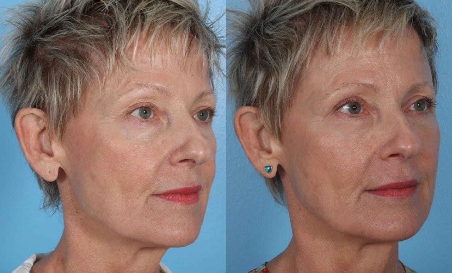 Limited Incision Facelift Before & After Gallery - Patient 289303 - Image 2