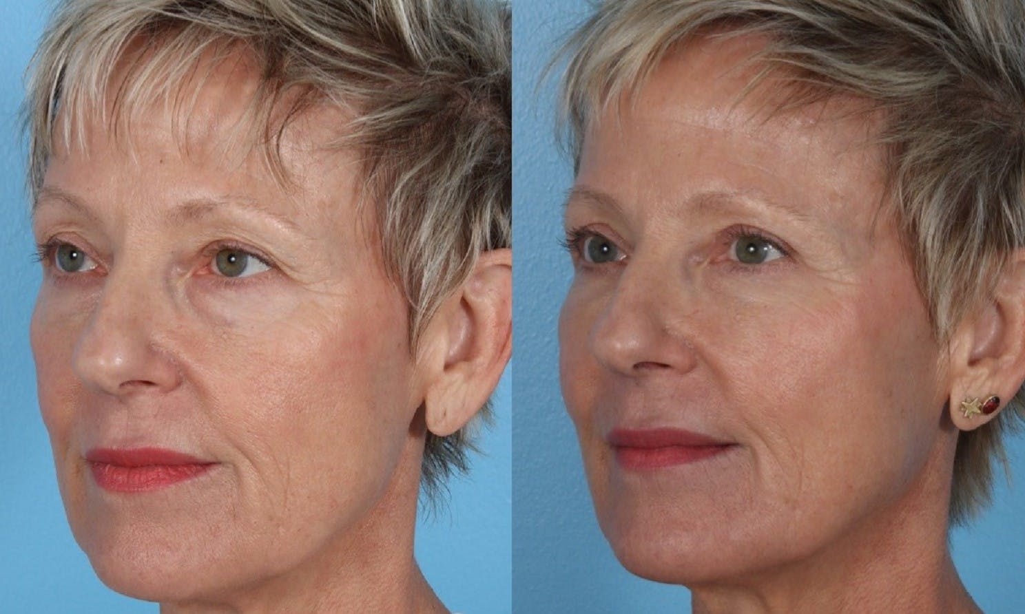 Limited Incision Facelift Before & After Gallery - Patient 289303 - Image 4
