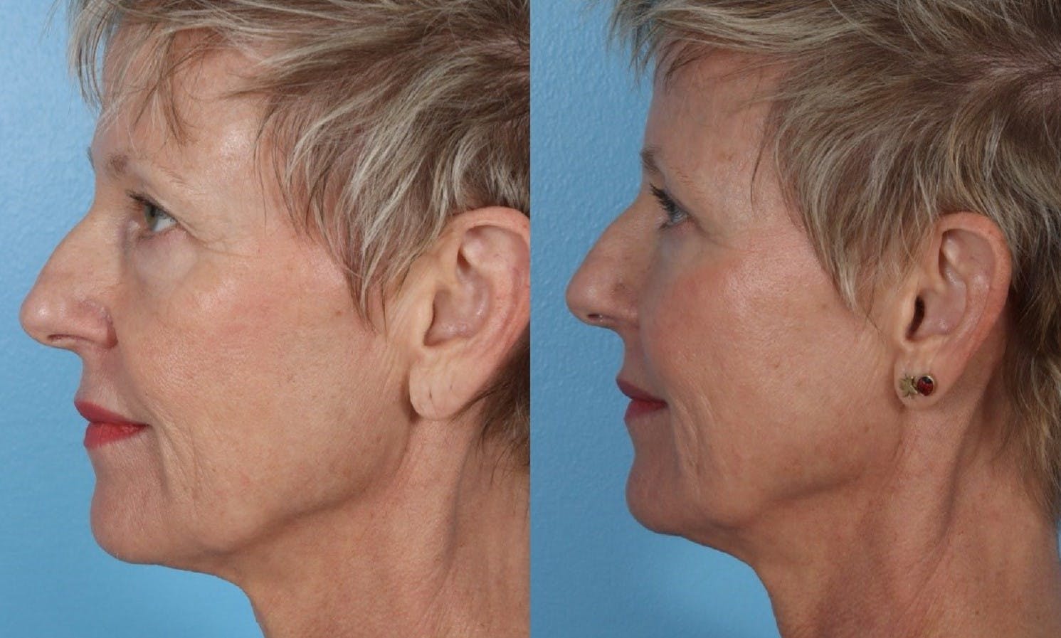 Limited Incision Facelift Before & After Gallery - Patient 289303 - Image 5
