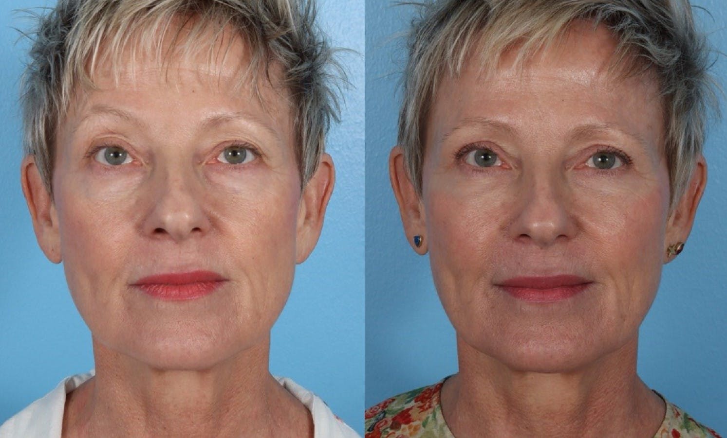 Limited Incision Facelift Before & After Gallery - Patient 289303 - Image 1