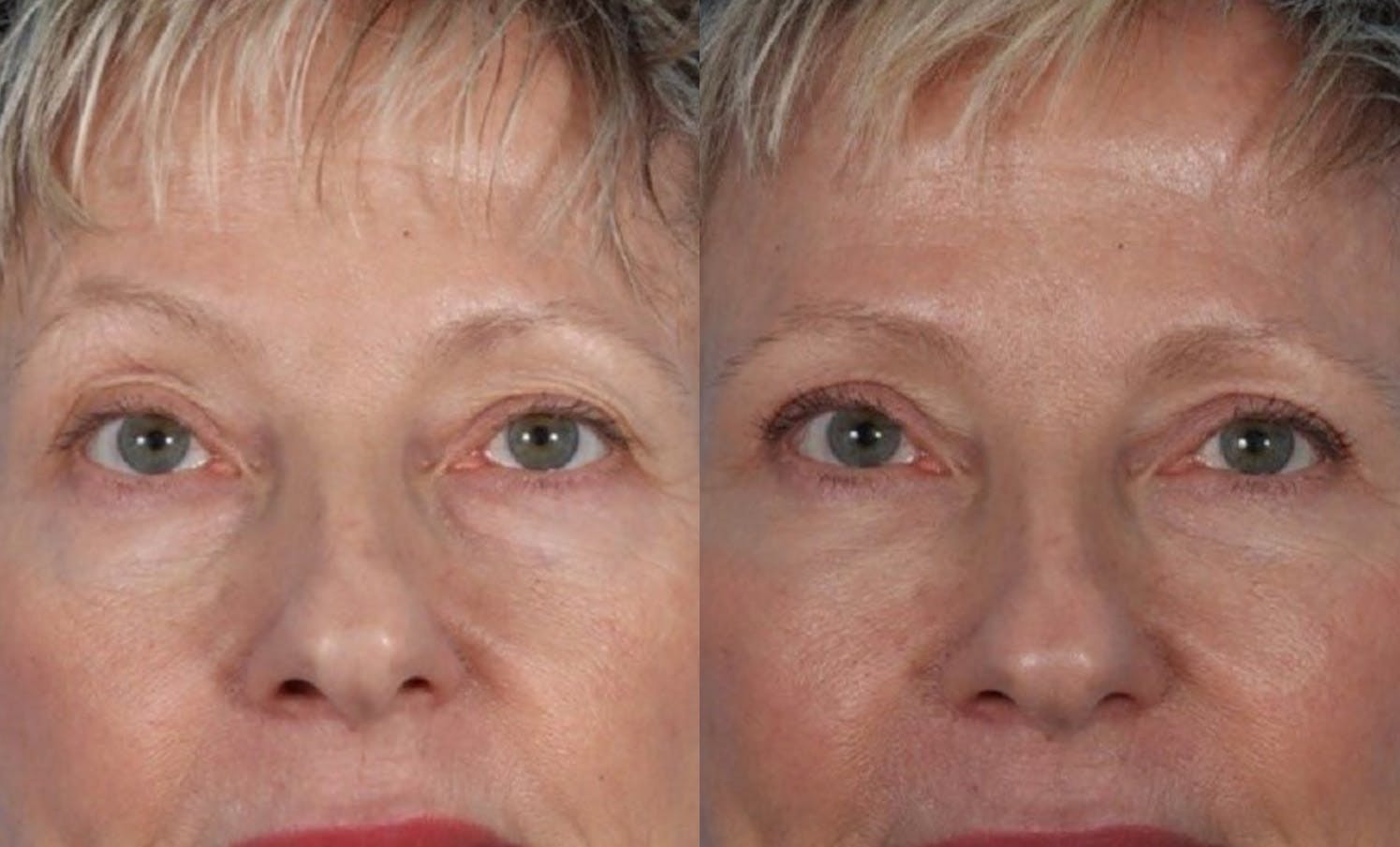 Limited Incision Facelift Before & After Gallery - Patient 289303 - Image 6