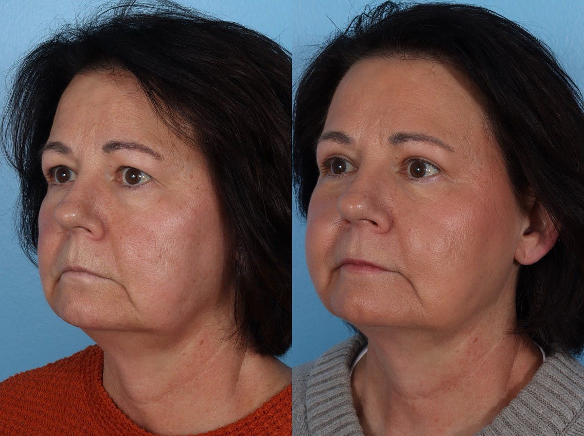Eyelid Surgery (Blepharoplasty) Before & After Gallery - Patient 285727 - Image 2