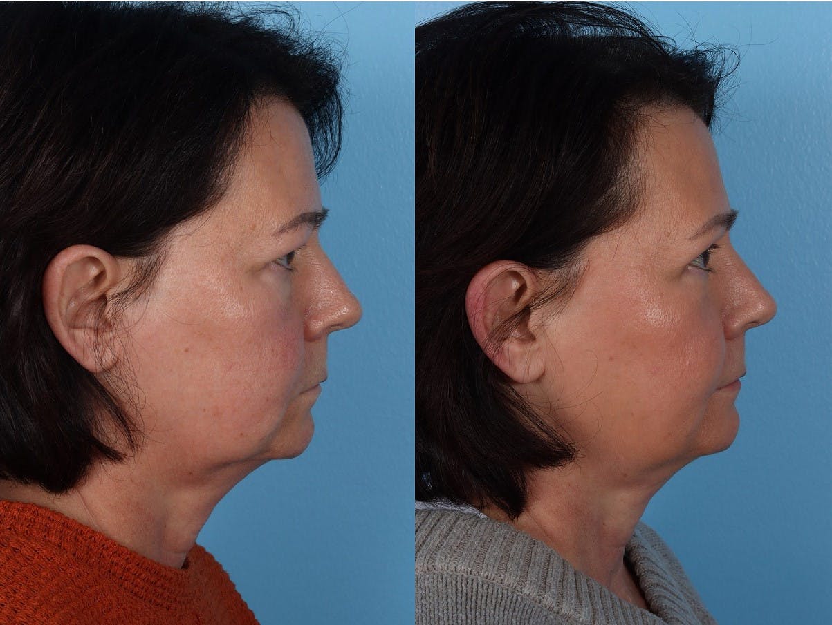 Eyelid Surgery (Blepharoplasty) Before & After Gallery - Patient 285727 - Image 3