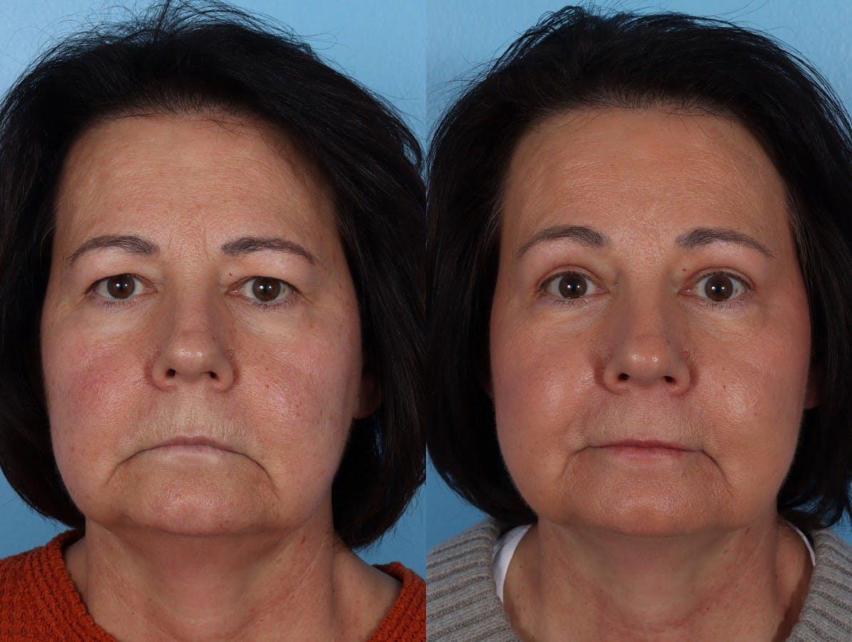 Eyelid Surgery (Blepharoplasty) Before & After Gallery - Patient 285727 - Image 1