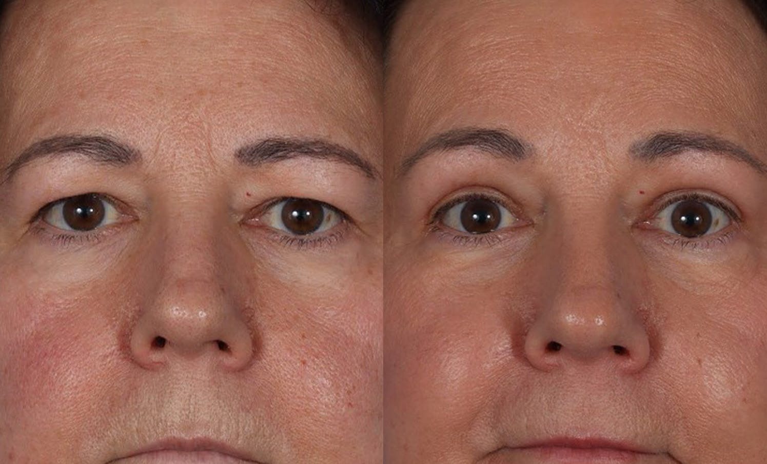 Eyelid Surgery (Blepharoplasty) Before & After Gallery - Patient 285727 - Image 4