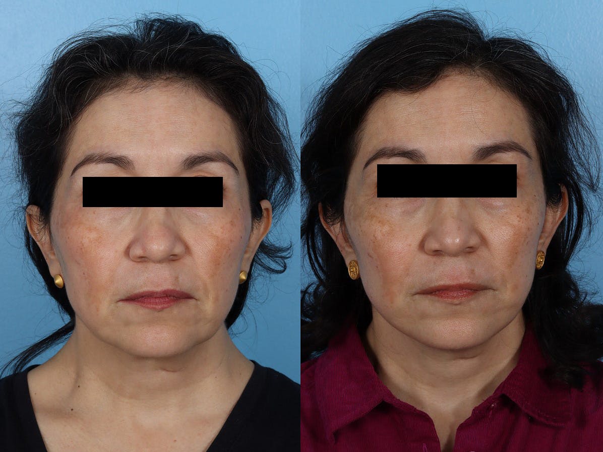 Limited Incision Facelift Before & After Gallery - Patient 259175 - Image 1