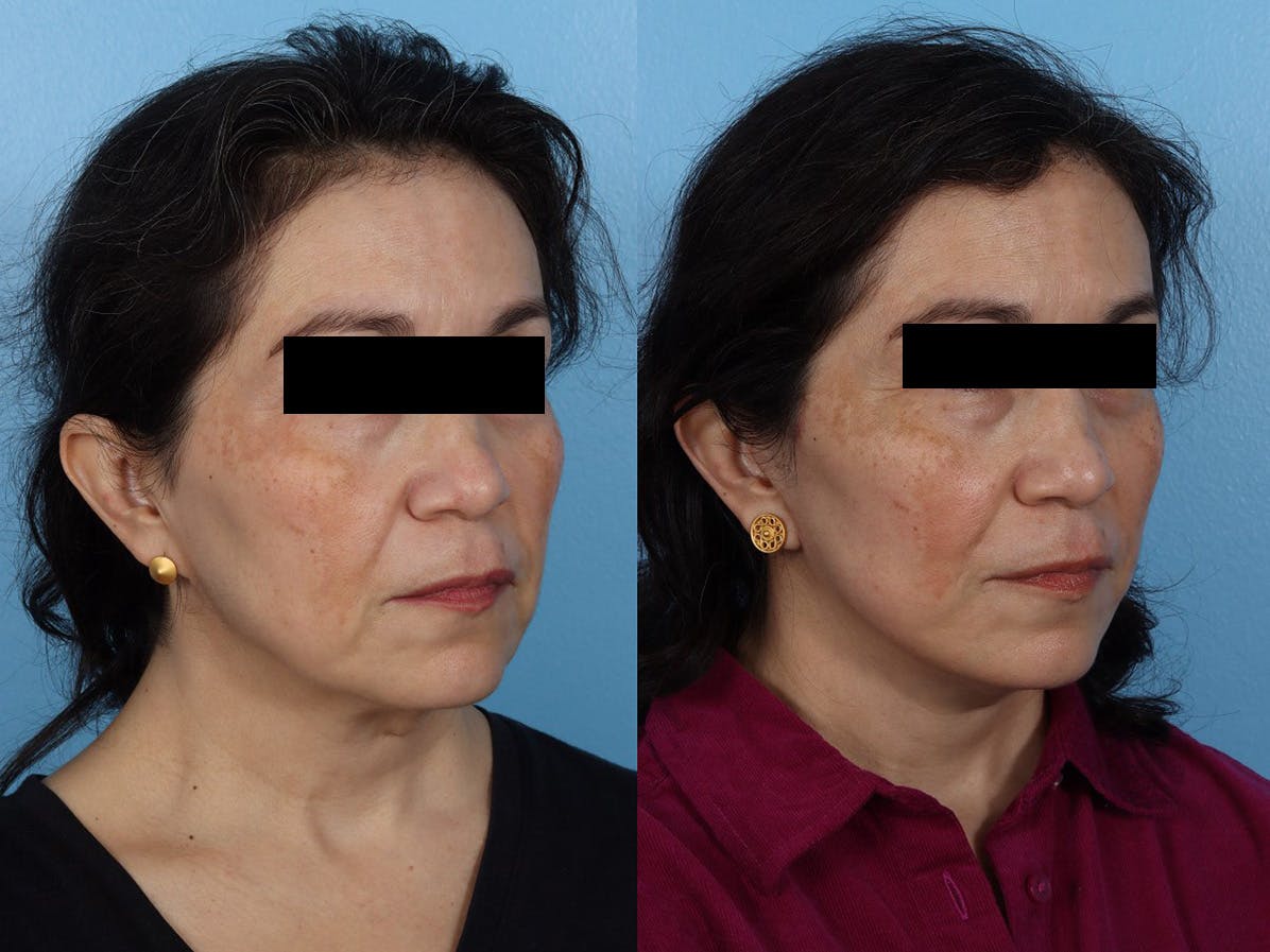 Limited Incision Facelift Before & After Gallery - Patient 259175 - Image 2