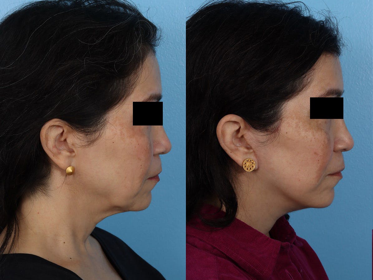 Limited Incision Facelift Before & After Gallery - Patient 259175 - Image 3