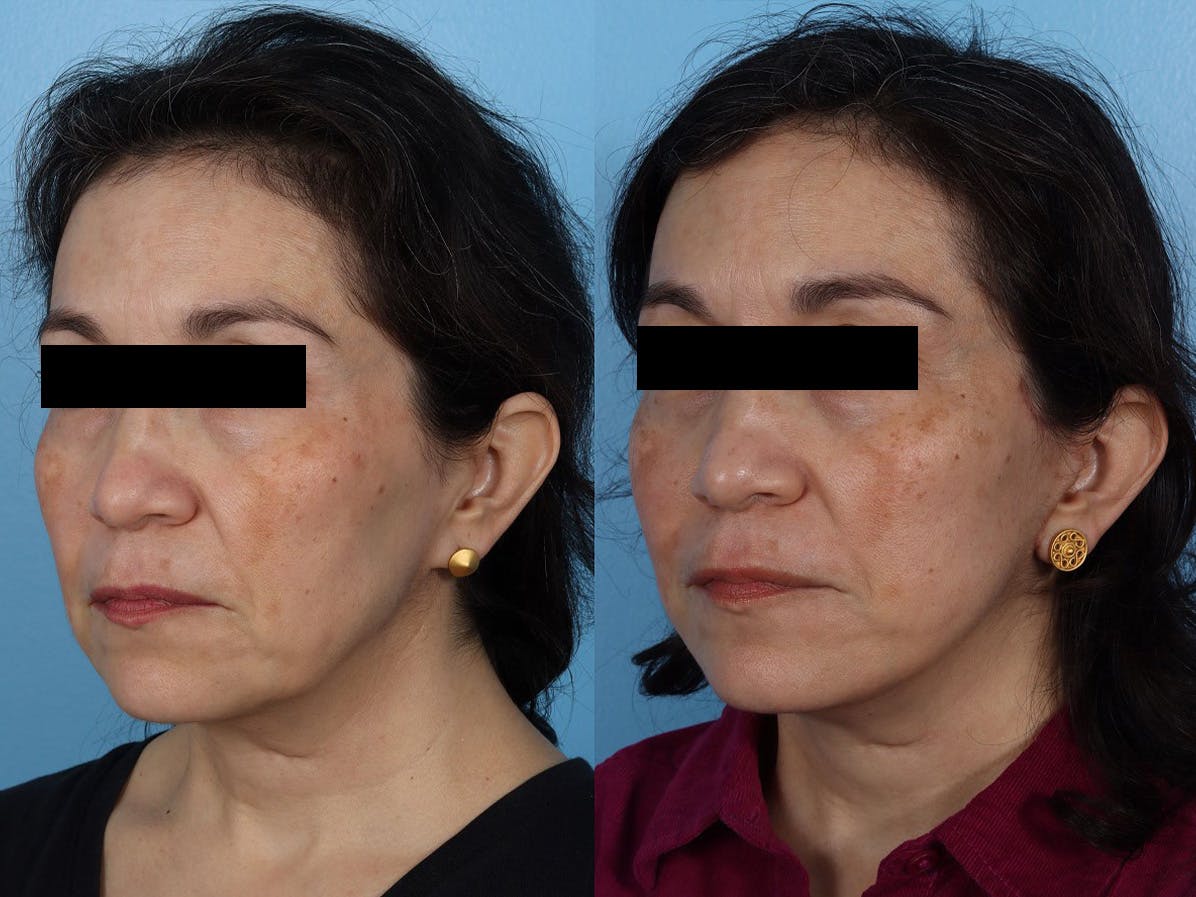 Limited Incision Facelift Before & After Gallery - Patient 259175 - Image 4
