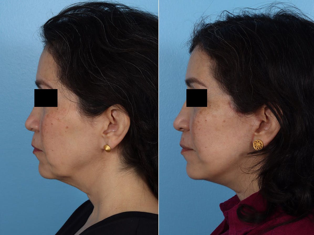 Limited Incision Facelift Before & After Gallery - Patient 259175 - Image 5