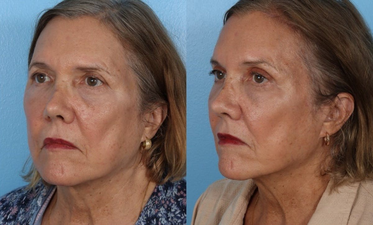 Endoscopic Browlift Before & After Gallery - Patient 285771 - Image 4