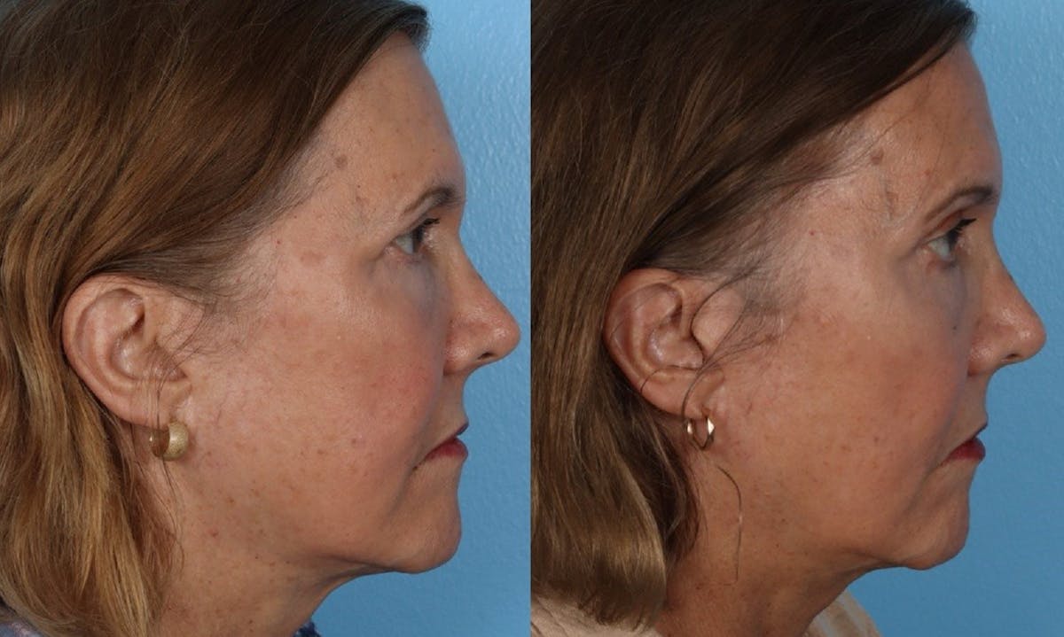 Endoscopic Browlift Before & After Gallery - Patient 285771 - Image 3