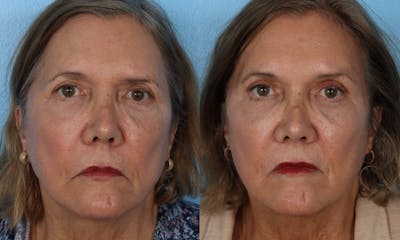 Endoscopic Browlift Before & After Gallery - Patient 285771 - Image 1
