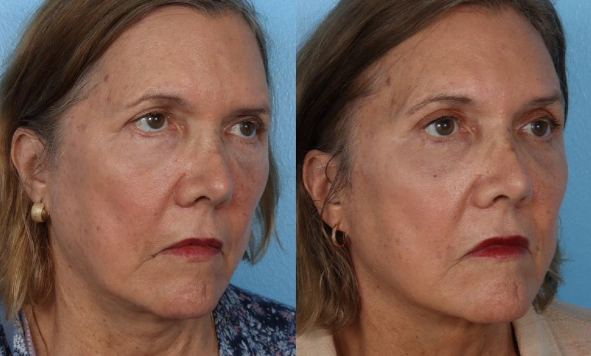 Endoscopic Browlift Before & After Gallery - Patient 285771 - Image 2