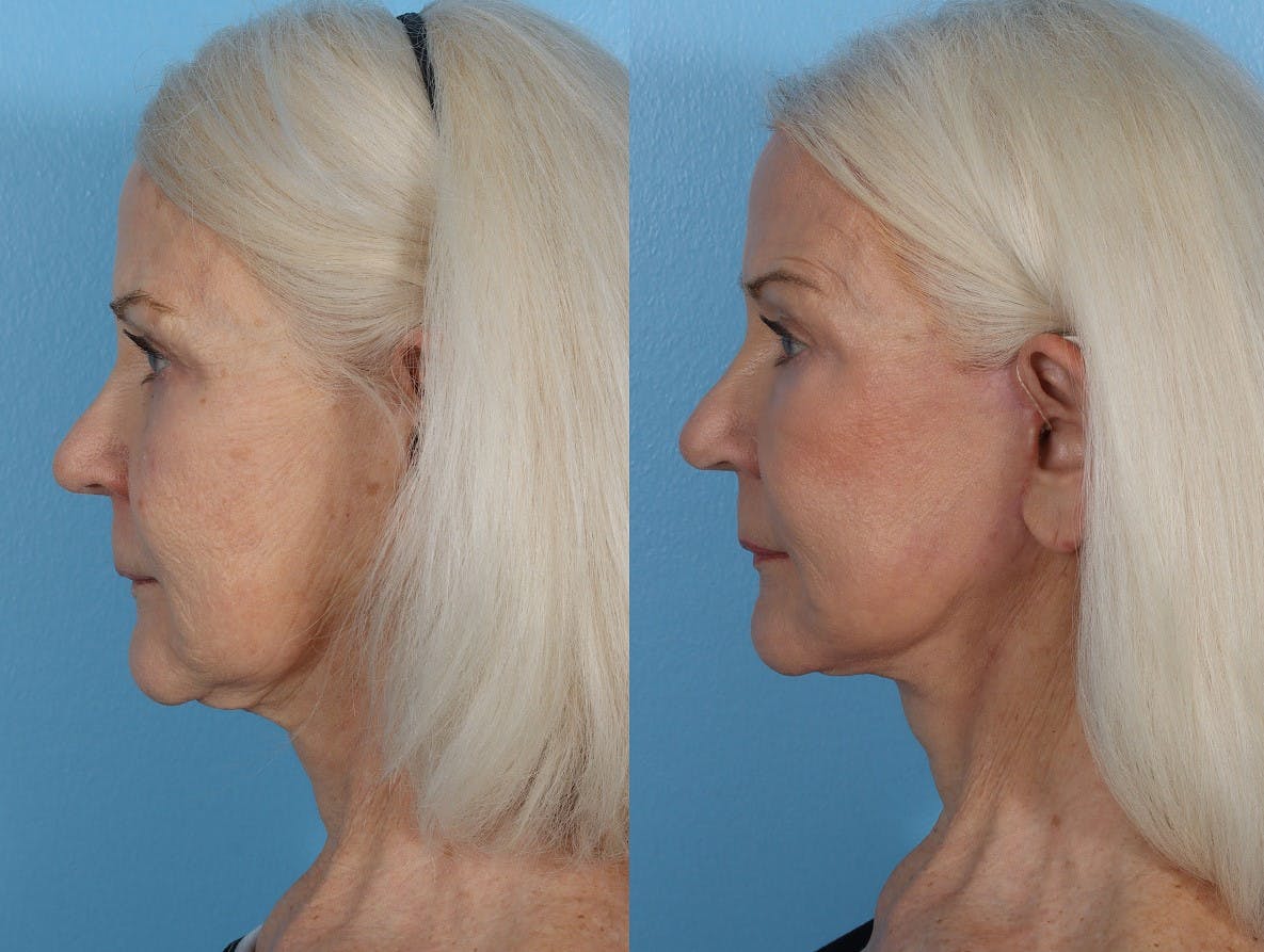 CO2 Fractional Laser Before & After Gallery - Patient 191375 - Image 4