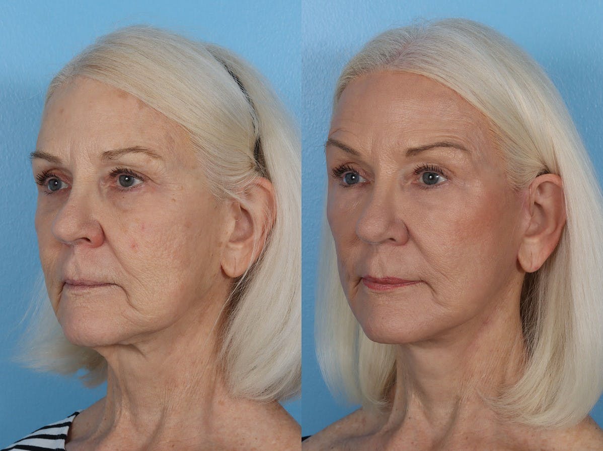 CO2 Fractional Laser Before & After Gallery - Patient 191375 - Image 3