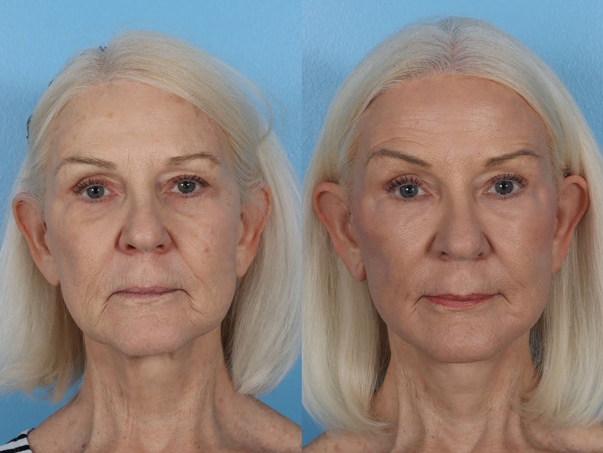 CO2 Fractional Laser Before & After Gallery - Patient 191375 - Image 1
