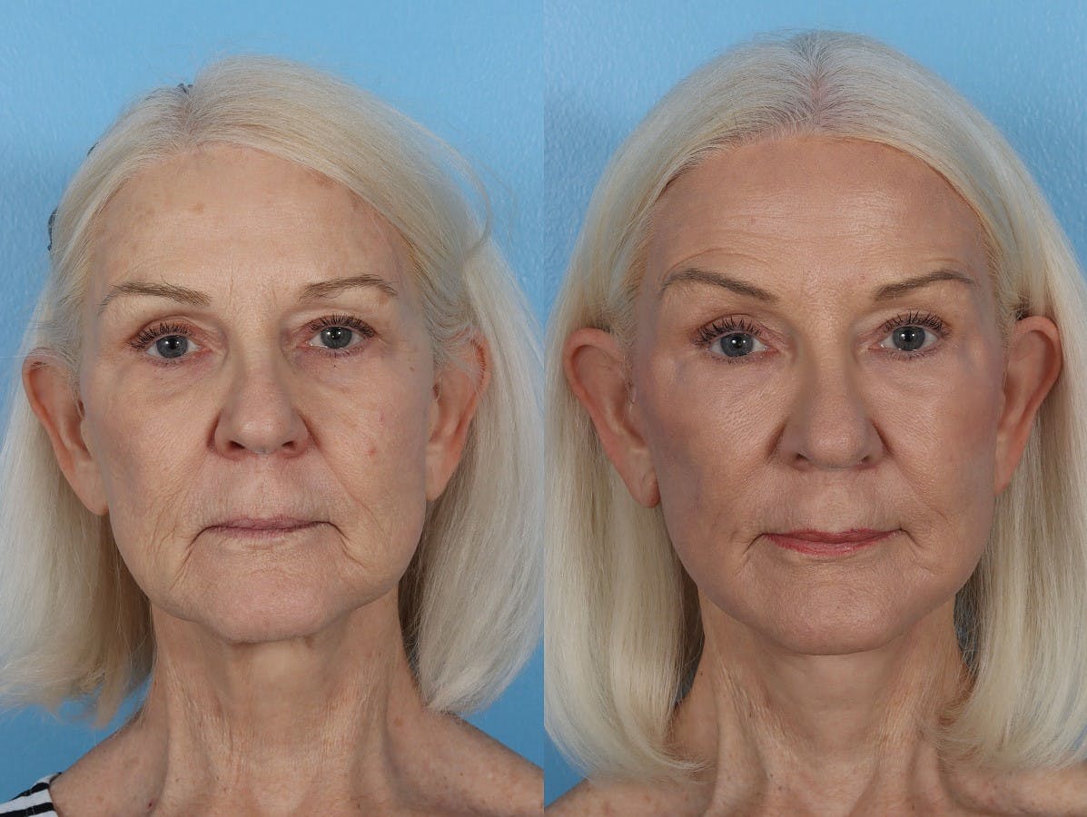 CO2 Fractional Laser Before & After Gallery - Patient 191375 - Image 1