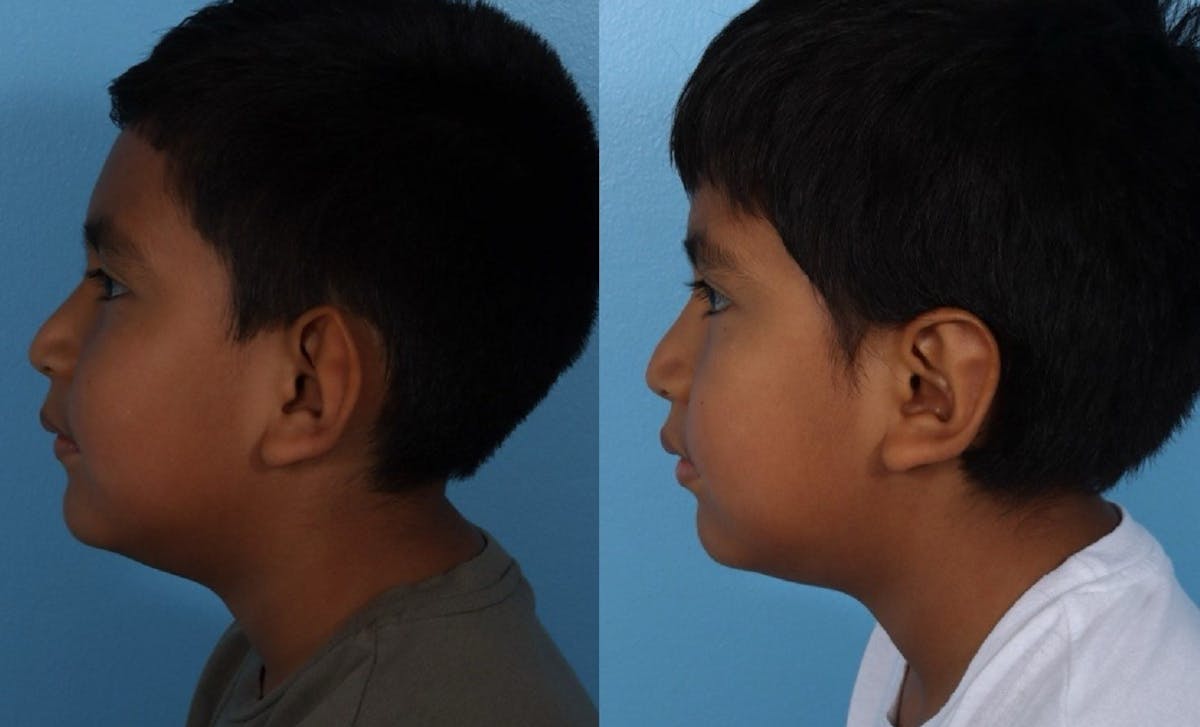 Ear Surgery (Otoplasty) Before & After Gallery - Patient 227666 - Image 5