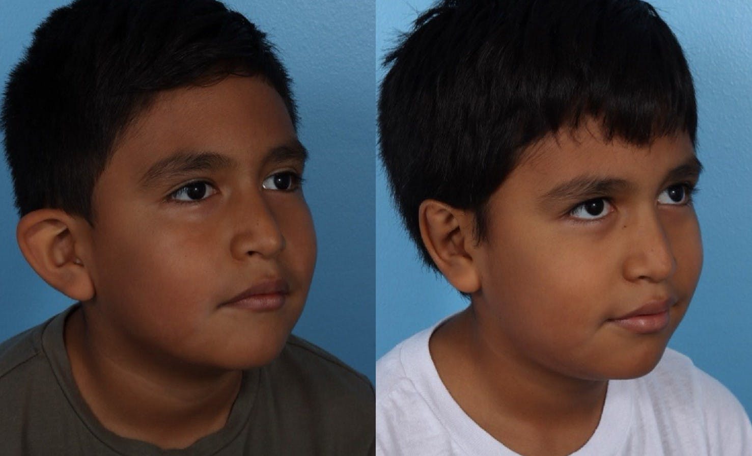 Ear Surgery (Otoplasty) Before & After Gallery - Patient 227666 - Image 2