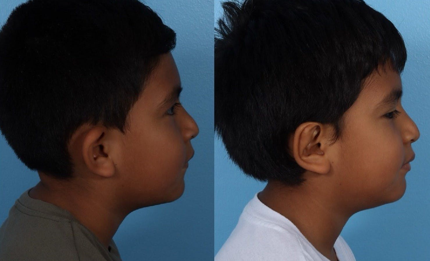 Ear Surgery (Otoplasty) Before & After Gallery - Patient 227666 - Image 3
