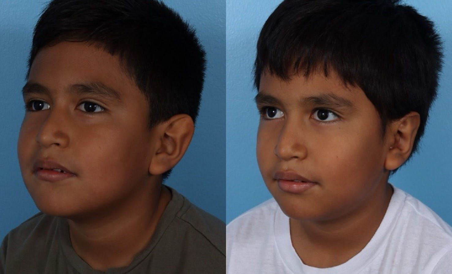 Ear Surgery (Otoplasty) Before & After Gallery - Patient 227666 - Image 4