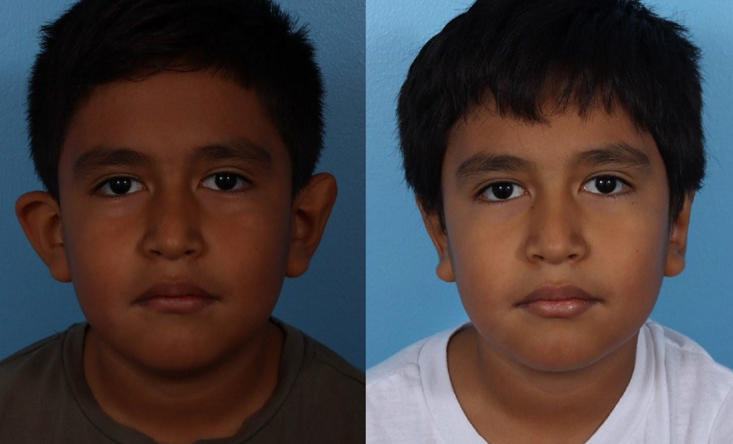 Ear Surgery (Otoplasty) Before & After Gallery - Patient 227666 - Image 1