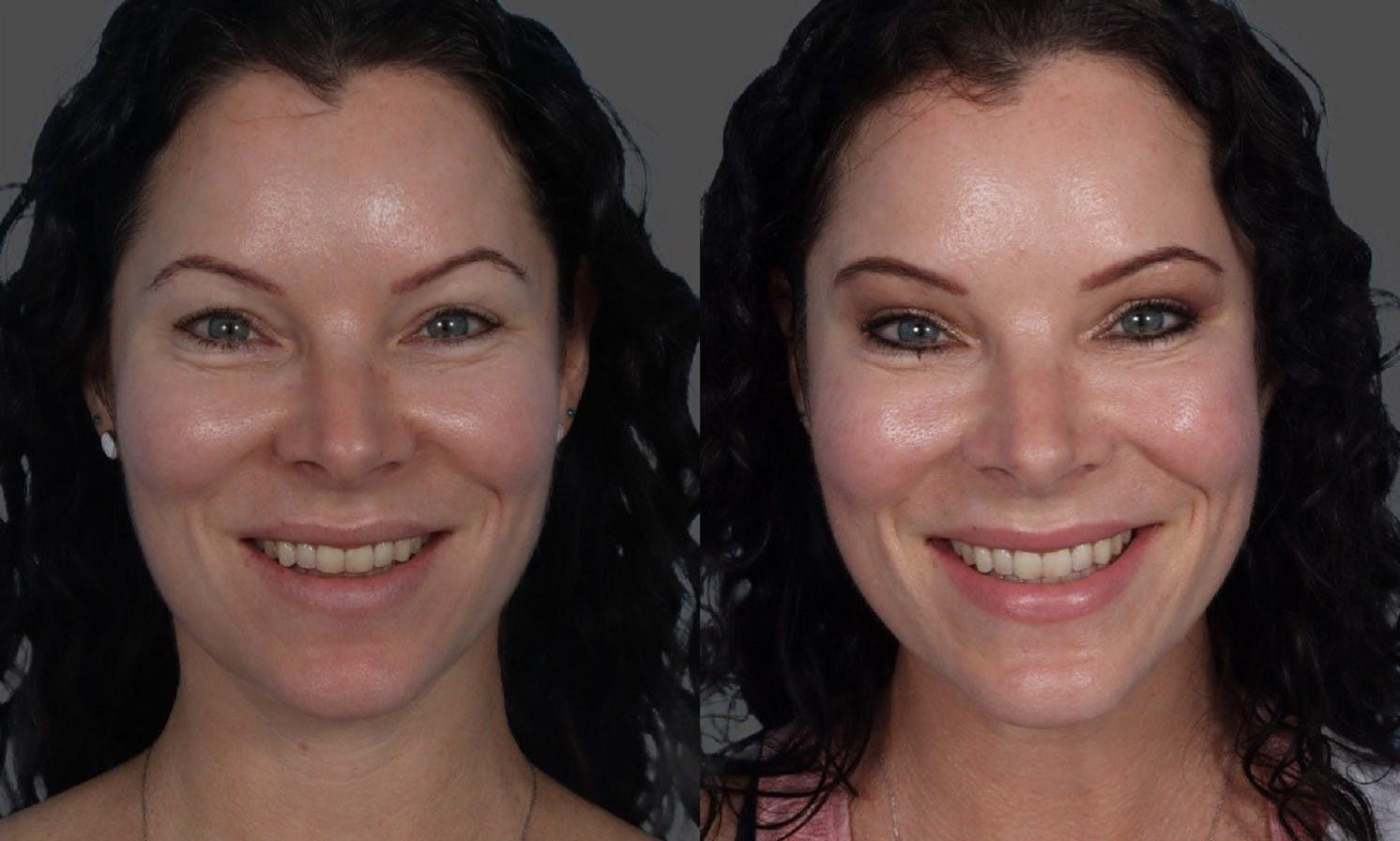 Eyelid Surgery (Blepharoplasty) Before & After Gallery - Patient 141813 - Image 1