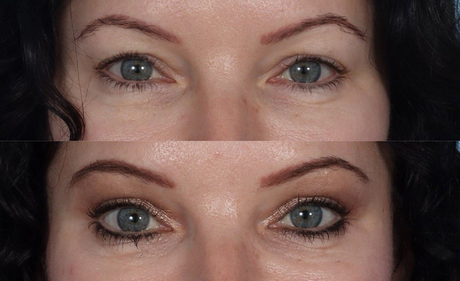 Eyelid Surgery (Blepharoplasty) Before & After Gallery - Patient 141813 - Image 2