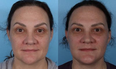 Facelift Before & After Gallery - Patient 689711 - Image 1