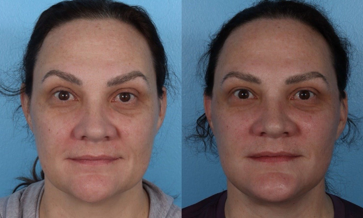 Facelift Before & After Gallery - Patient 689711 - Image 1
