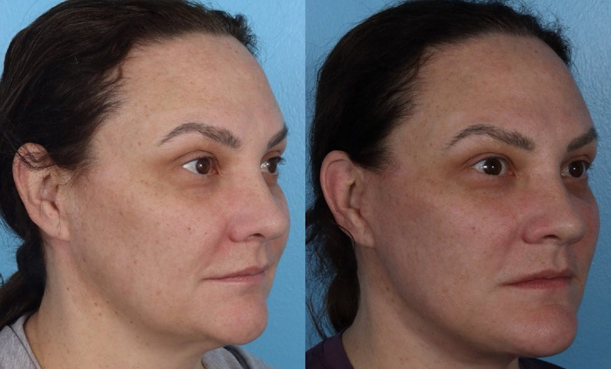 Facelift Before & After Gallery - Patient 689711 - Image 1