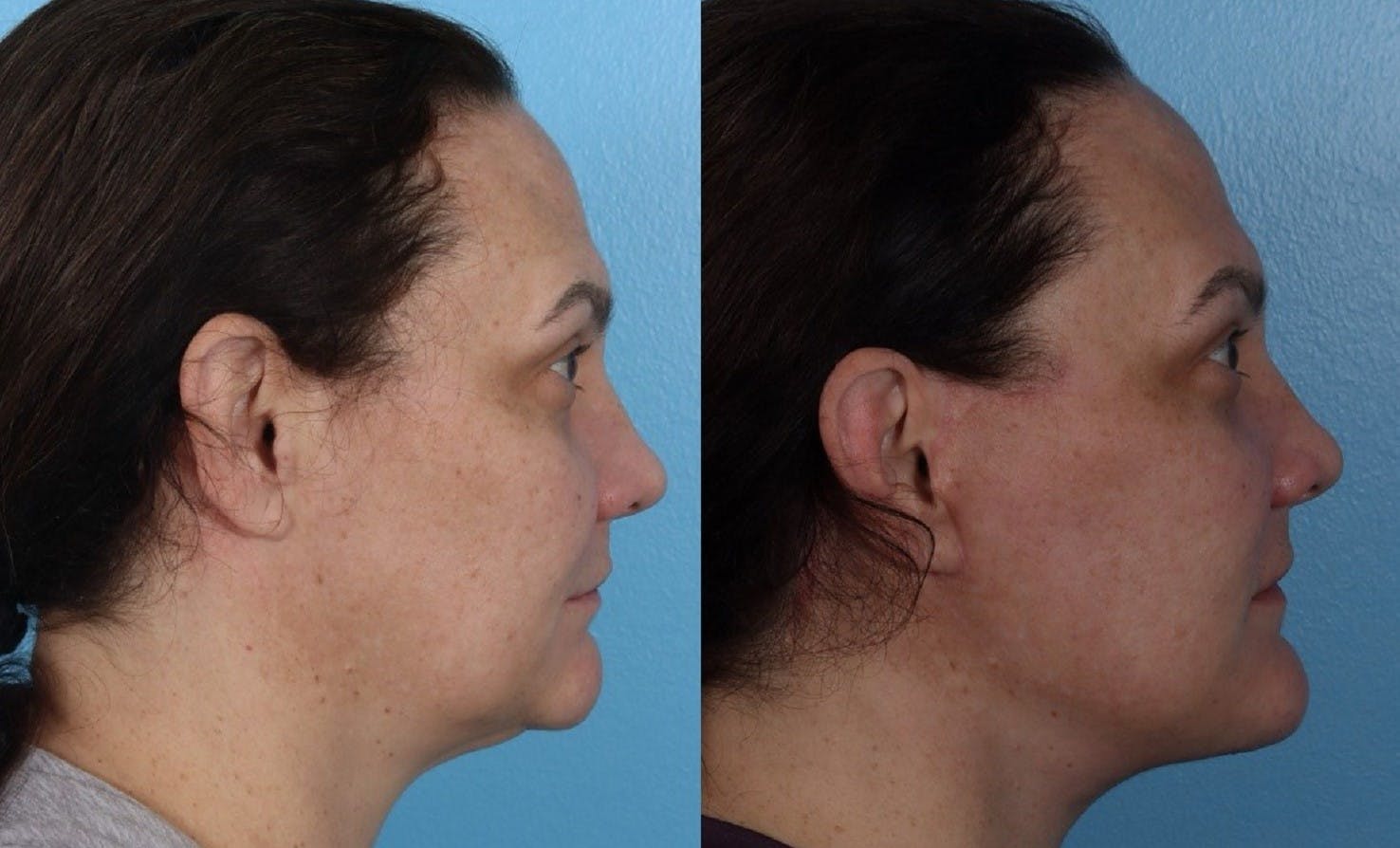 Facelift Before & After Gallery - Patient 689711 - Image 3