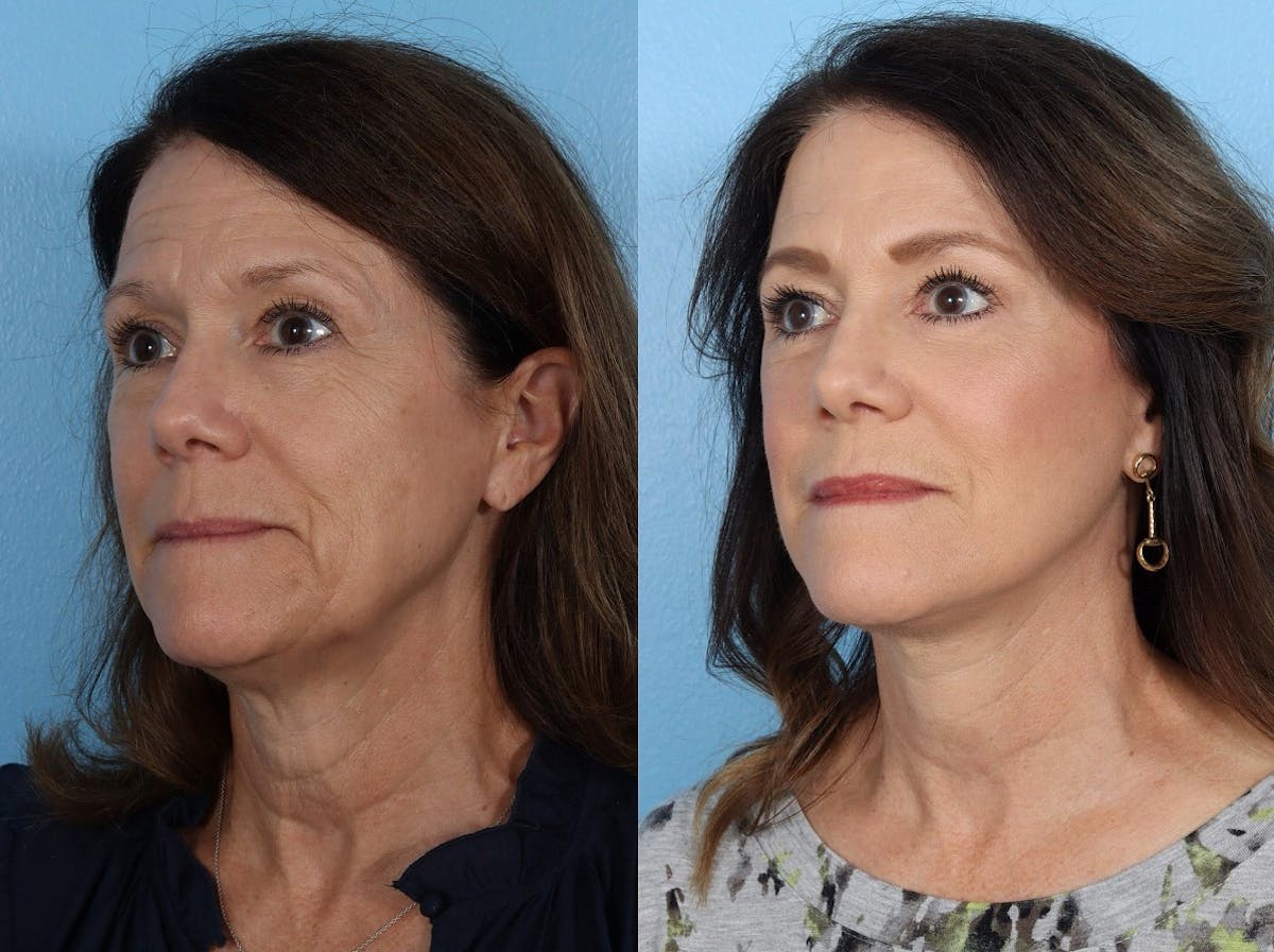 Facelift Before & After Gallery - Patient 242644 - Image 4