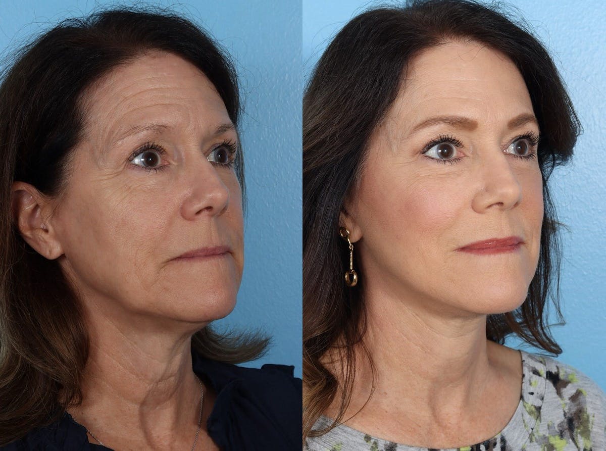 Facelift Before & After Gallery - Patient 242644 - Image 2