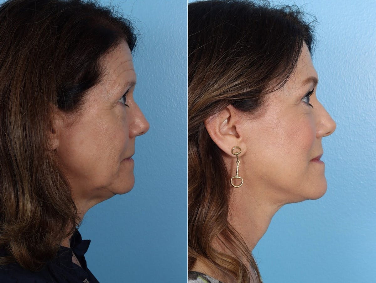 Facelift Before & After Gallery - Patient 242644 - Image 3