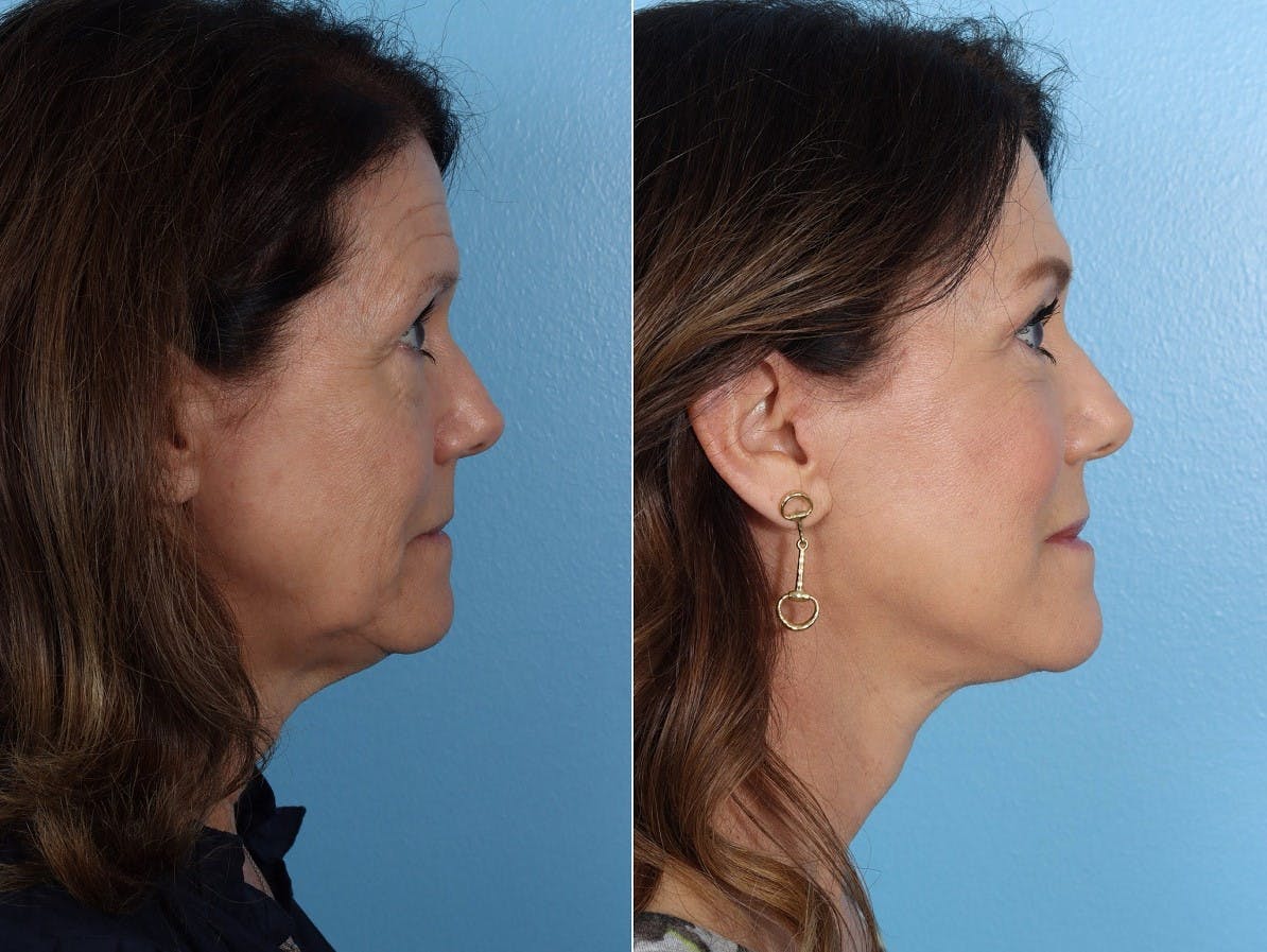 Eyelid Surgery (Blepharoplasty) Before & After Gallery - Patient 284783 - Image 3