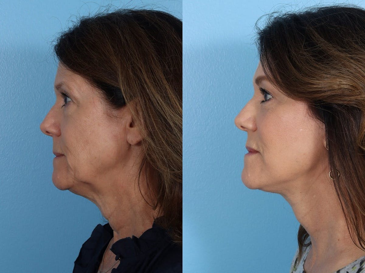 Facelift Before & After Gallery - Patient 242644 - Image 5