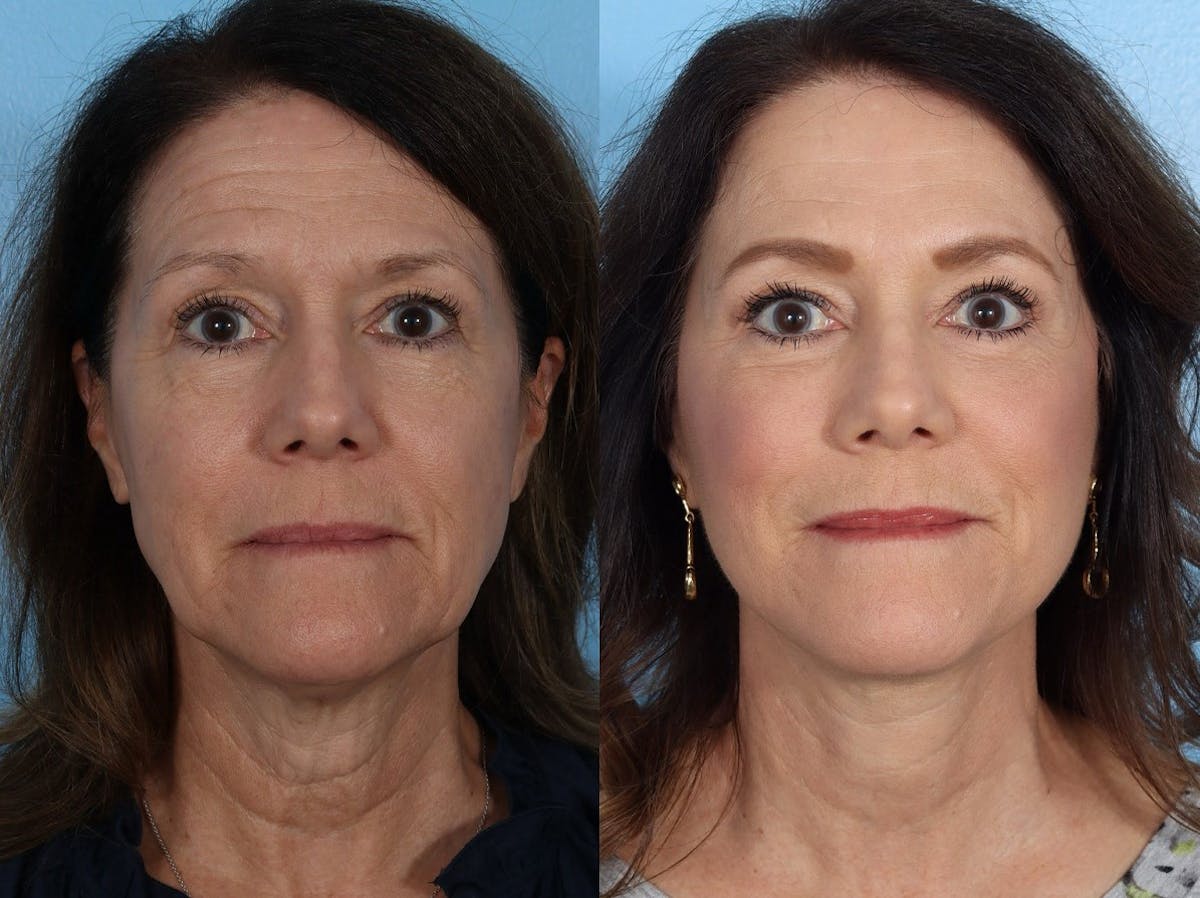 Facelift Before & After Gallery - Patient 242644 - Image 1