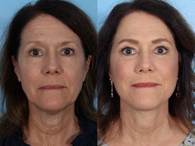 Eyelid Surgery (Blepharoplasty) Before & After Gallery - Patient 284783 - Image 1